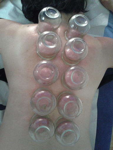 Schr�pfen, heilpraktiker sidirourgopoulos